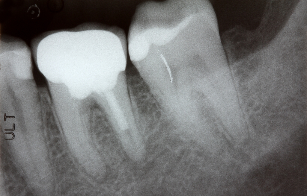 Digitalni zobni rentgen | VV Dental