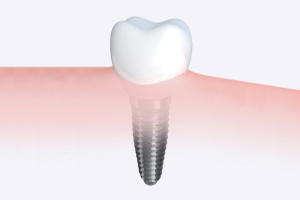 implantant