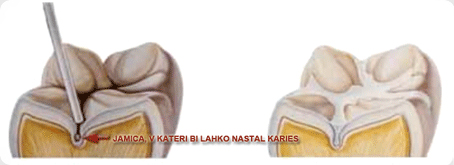preventiva_kariesa_z_zalivanjem_fisur